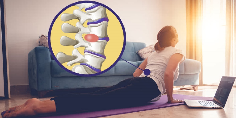 درمان دیسک کمر با ورزش