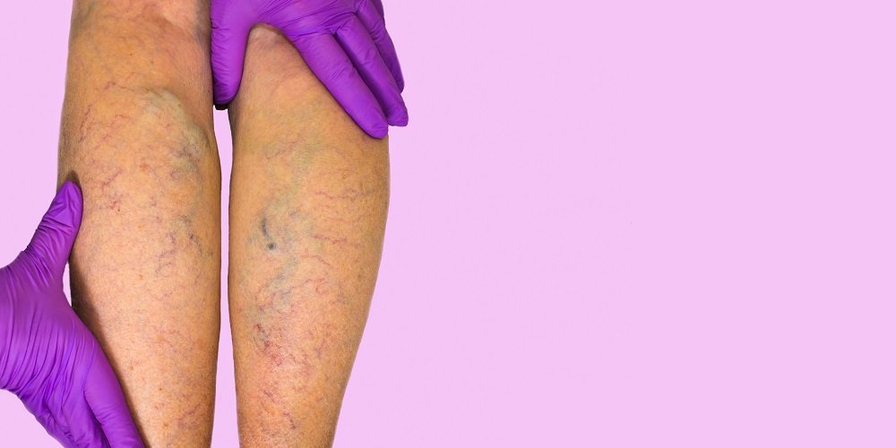 همه چیز درباره واریس و درمان آن - ایران فیتنس همه چیز درباره واریس و درمان آن