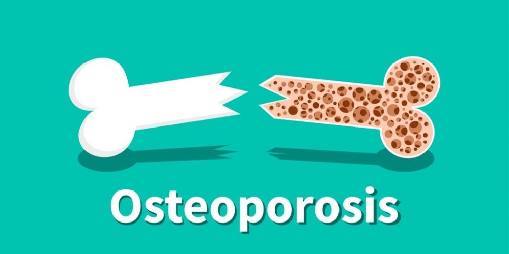 نشانه های پوکی استخوان و درمان آن - ایران فیتنس نشانه های پوکی استخوان و درمان آن