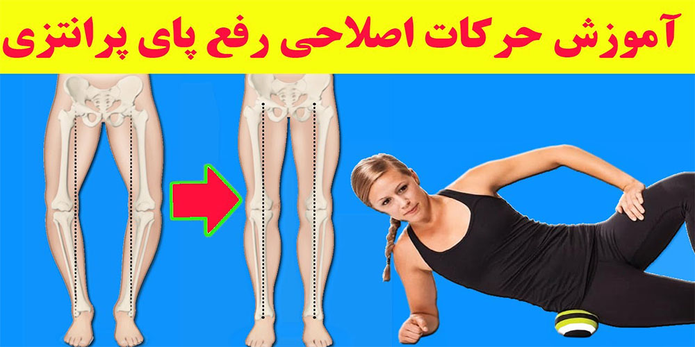 درمان پای پرانتزی با ورزش و حرکات اصلاحی - ایران فیتنس درمان پای پرانتزی با ورزش و حرکات اصلاحی